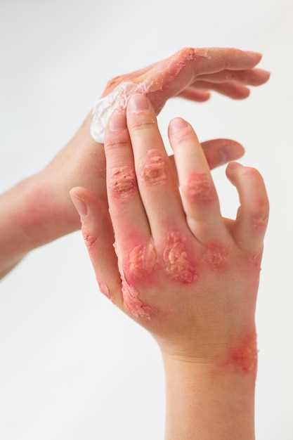 Симптомы аллергических высыпаний на коже: что нужно знать