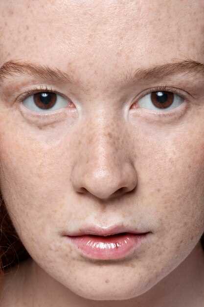 Фотодерматозы: Причины, Симптомы и Лечение